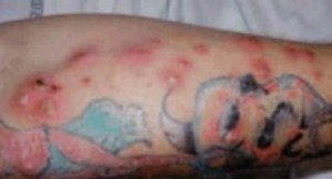 tattoo-infection-pictures-4