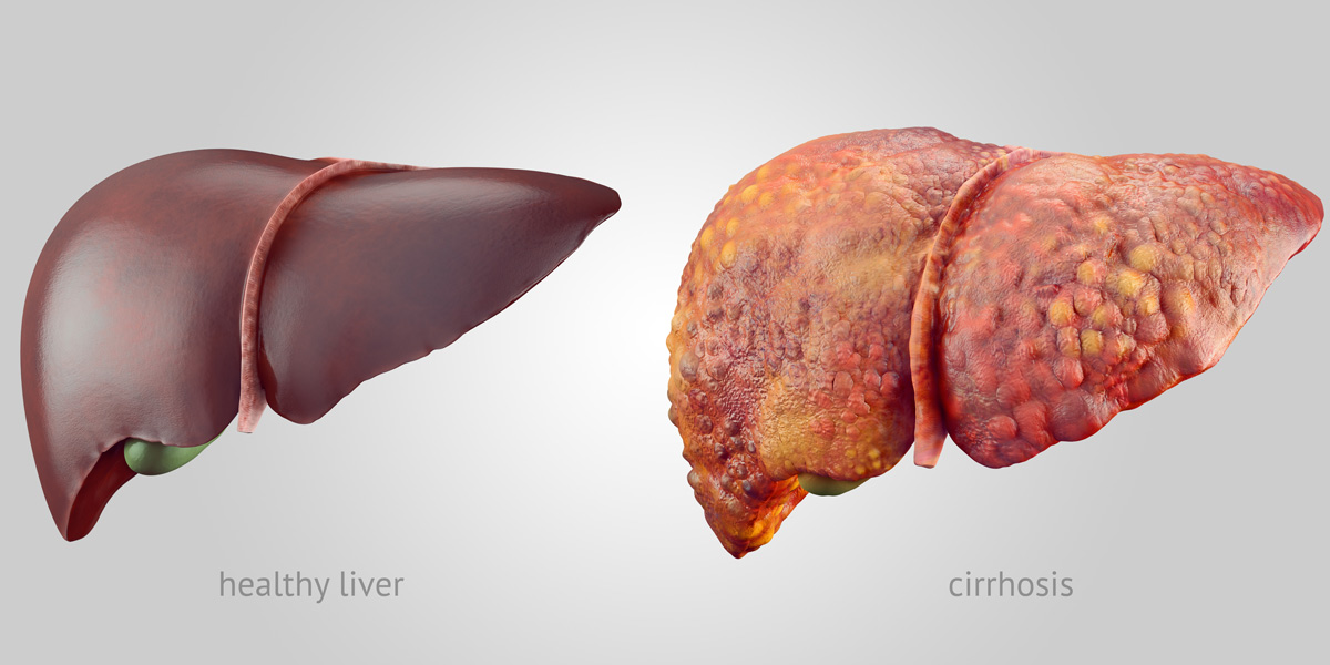 Health Liver and Unhealthy Liver